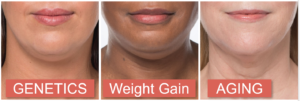 Learn More About Double Chin Treatment Near Me In Encinitas CA
