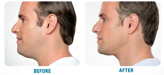 Double Chin Treatment Actual Results Near Me In Encinitas CA