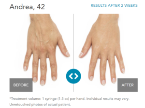 Hand Rejuvenation Treatment Actual Results Near Me In Encinitas CA