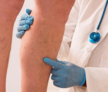New Options for Varicose Vein Removal