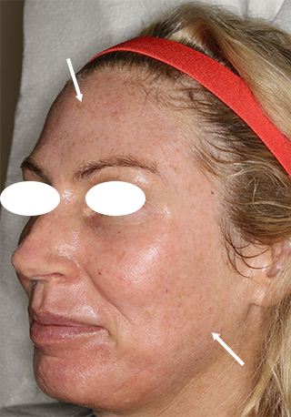 Before Fraxel Treatment