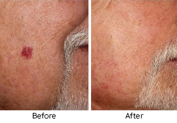 ExcelV Laser Treatment for Brown Spots near San Diego CA area